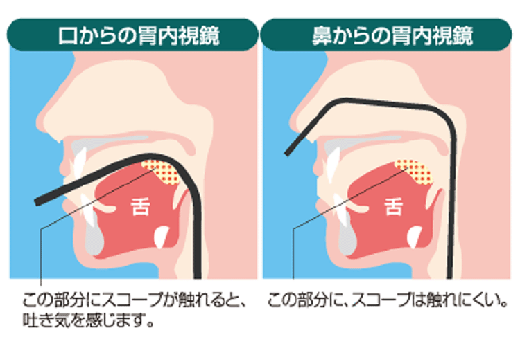 経鼻・経口説明図